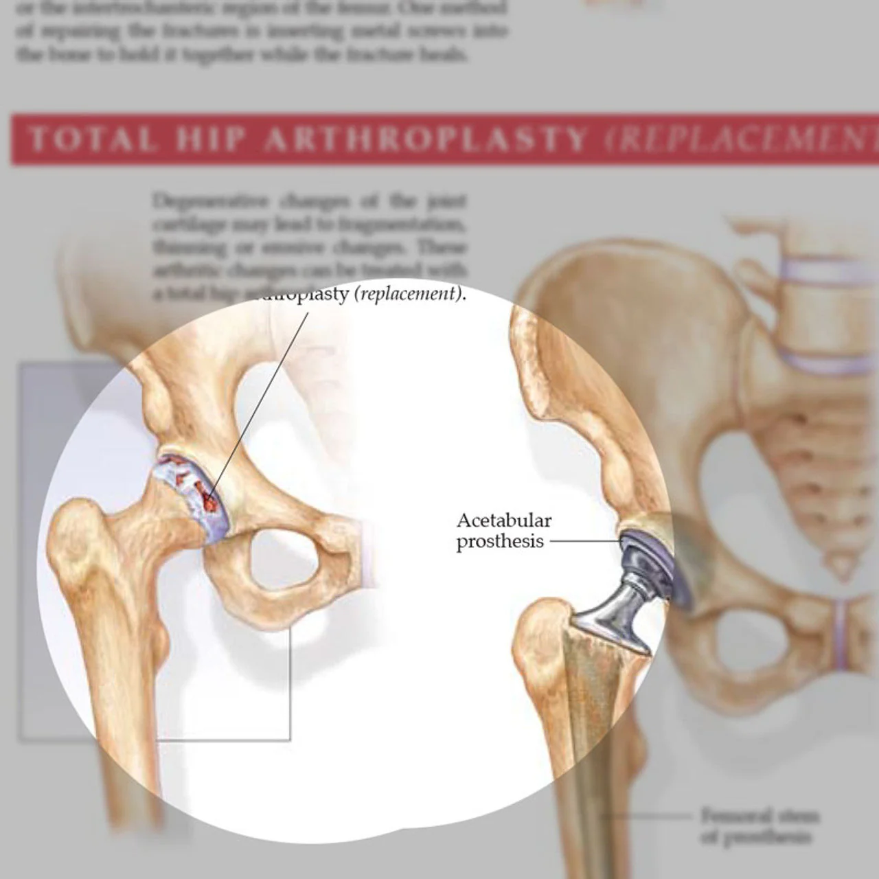 Anatomy and Injuries of the Hip (Laminated) - Image 3