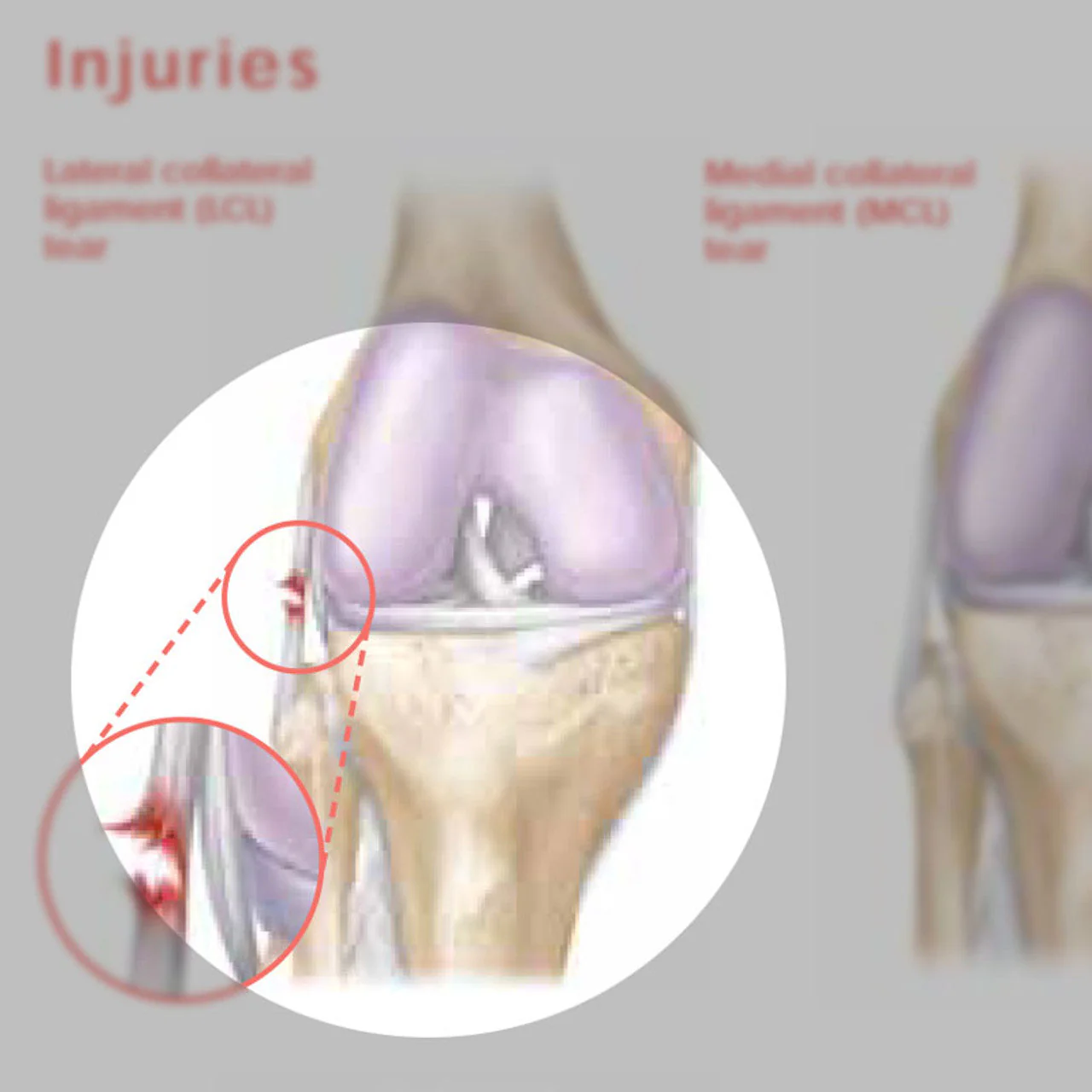 Athletic Injuries of the Knee ( Laminated) - Image 4