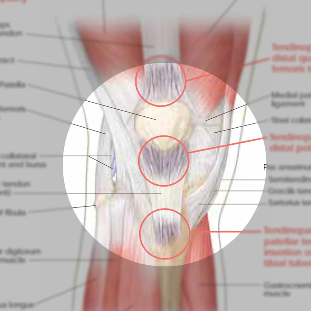 Athletic Injuries of the Knee ( Laminated) - Image 3